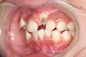 埋伏歯の牽引